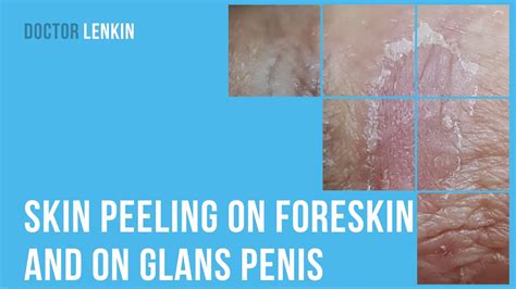 glans discoloration pictures|rough skin on penis head.